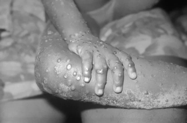 1280px-monkeypox