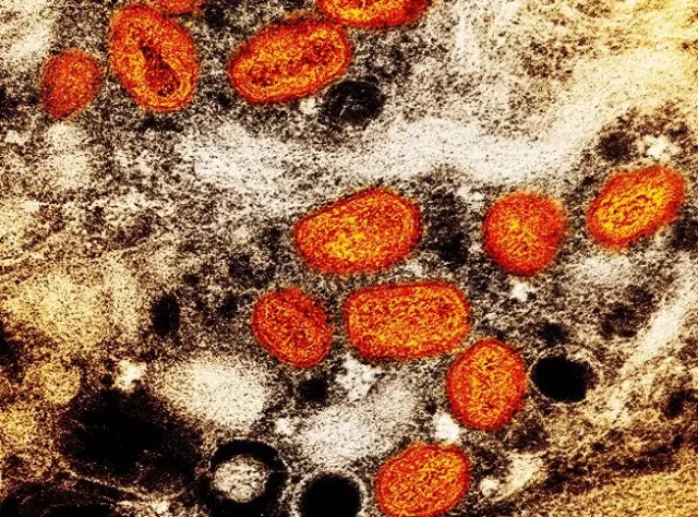 monkeypox-13